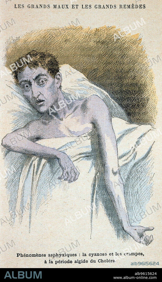 Cholera patient. Patient in typical cholera attitude. From French medical book published c1890.