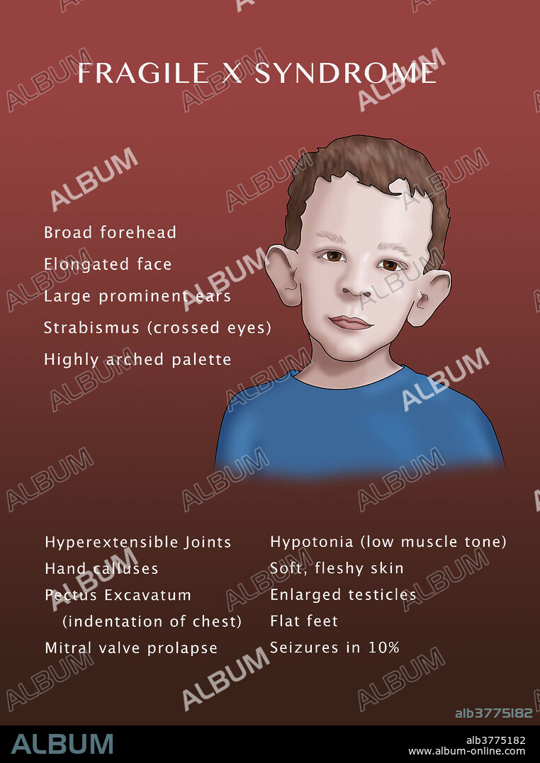 Fragile X syndrome symptoms. Illustration.