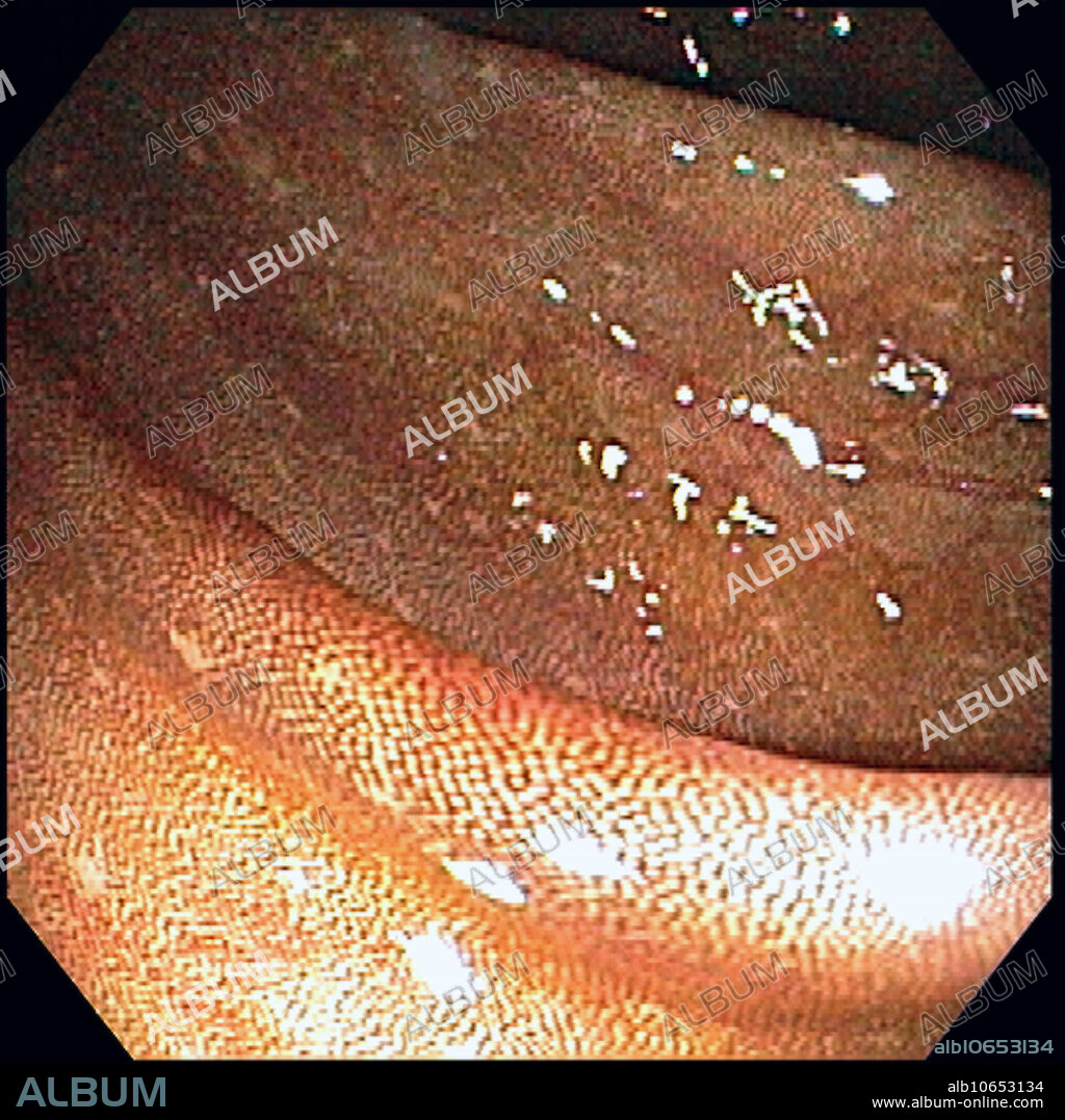 A benign condition of the colon due to deposition of melanin, a black pigment, in the colon. This is associated with laxative abuse, particularly anthracene type cathartics: cascacara, senna, aloe, rhubarb and frangula. Cessation of the laxative results in disappearance of the pigmentation. Lymph follicles and polyps do not take up the pigment.