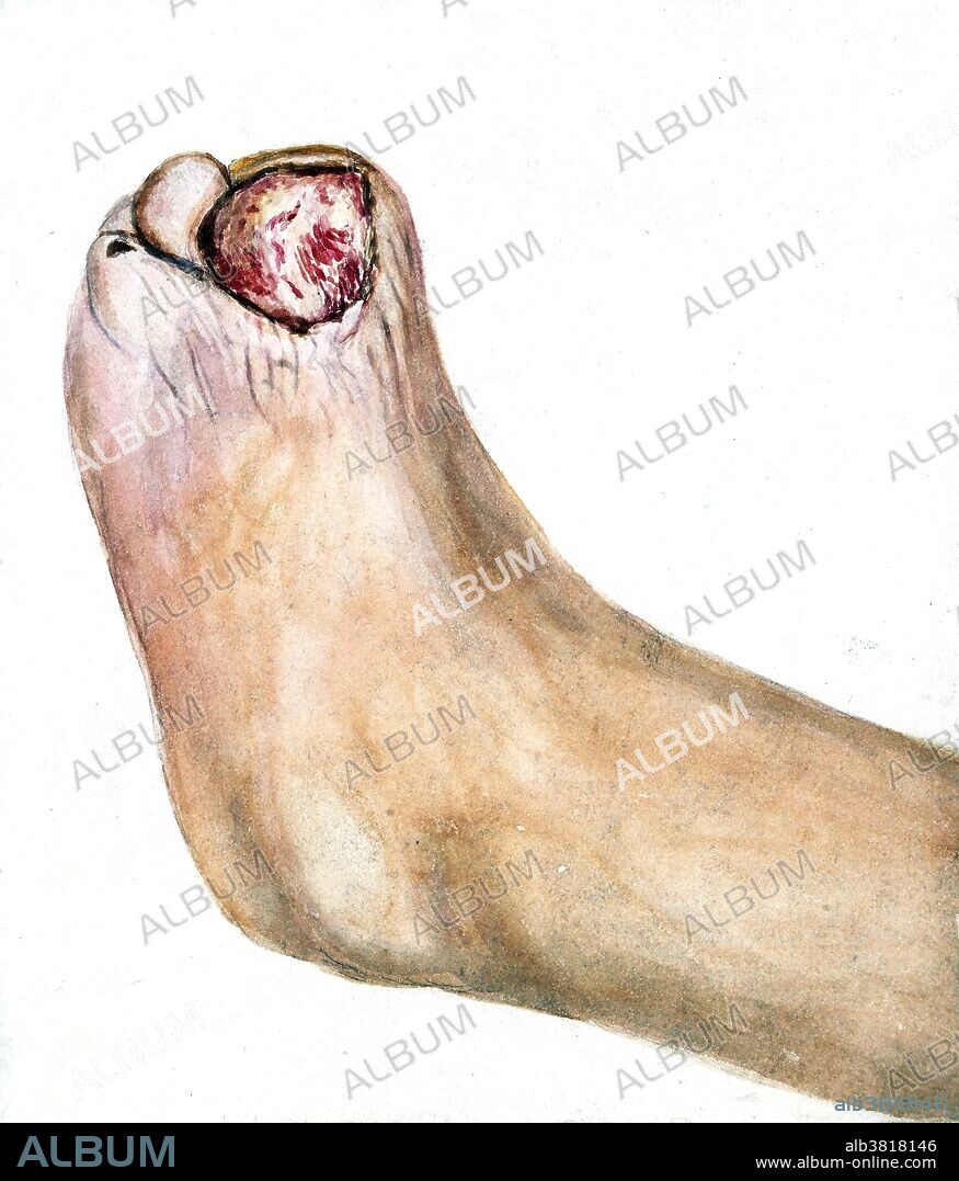 Chronic perforating ulcer of the foot. Watercolor drawing of the left foot of a man aged 47 years. As the result of a perforating ulcer of long standing, the great toe has entirely disappeared, leaving an ulcerated area measuring nearly two inches in diameter. Drawn by Leonard Mark.