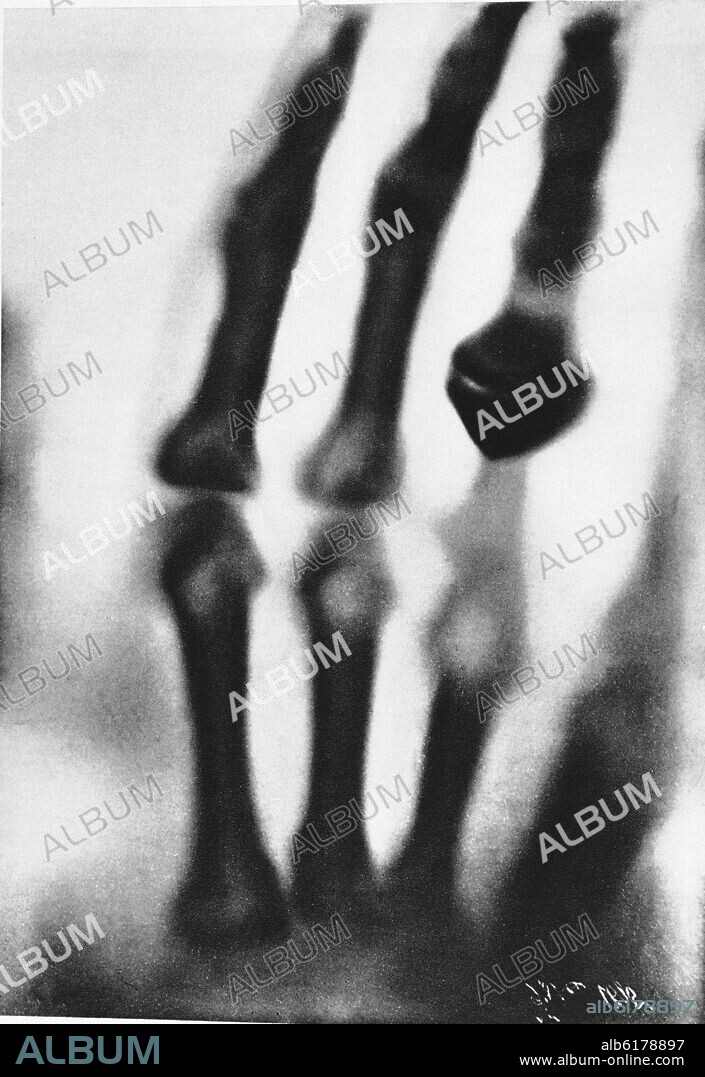 WILHEM ROENTGEN. INVENTION OF X-RAYS IN 1895 - RADIOGRAPHY OF ONE HAND. NOBEL PRIZE FOR PHYSICS IN 1901.
