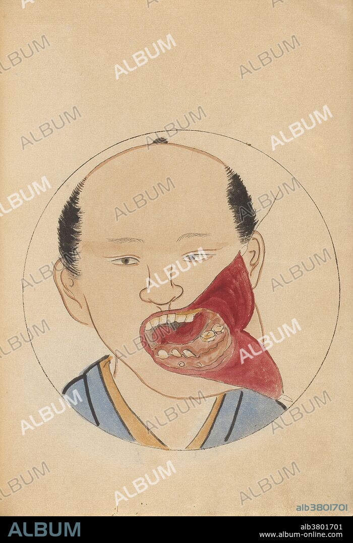 Man, 22 years old man, works in a book shop in Kyoto, illustrates the approach the surgeon will take (or has taken) to access and remove the patient's tumor. "A Surgical Casebook" is a manuscript of hand-painted pictures commissioned by Hanaoka Seishu. The colorful, often charming, pictures in this casebook capture the likenesses of the men and women who came to Hanaoka for treatment, and they depict graphically the medical and surgical problem to be treated. Hanaoka Seishu (October 23, 1760 - November 21, 1835) was a Japanese surgeon with a knowledge of Chinese herbal medicine, as well as Western surgical techniques. He successfully operated for hydrocele, anal fistula, and even performed certain kinds of plastic surgery. He was the first surgeon in the world who used the general anesthesia in surgery and who dared to operate on cancers of the breast and oropharynx, to remove necrotic bone, and to perform amputations of the extremities in Japan. He also devised and modified surgical instruments, and trained and educated many students, using his own philosophy for medical management. He died in 1835 at the age of 75.