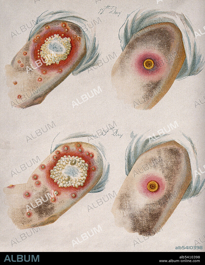 A comparison between smallpox and cowpox pustules on the 12th and 13th day of the disease. Cowpox (orthopoxvirus family) is an infectious disease caused by the cowpox virus. The virus is zoonotic, meaning that it is transferable between species, such as from animal to human. The transferral of the disease was first observed in dairymaids who touched the udders of infected cows and consequently developed the signature pustules on their hands. Cowpox is similar to, but much milder than, the highly contagious and often deadly smallpox disease. Its close resemblance to the mild form of smallpox and the observation that dairy farmers were immune from smallpox inspired the first smallpox vaccine, created and administered by English physician Edward Jenner. Once vaccinated, a patient develops antibodies that make them immune to cowpox, but they also develop immunity to the smallpox virus, or Variola virus. Chromolithograph, after George Kirtland, 1896.