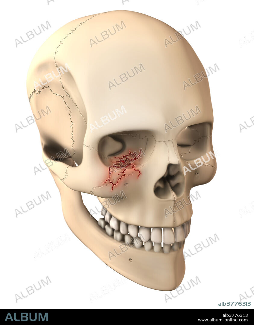 An illustration of an orbital blowout fracture in which the walls or floor of the orbit fracture due to blunt force trauma to the face around the eye socket. The force of the blow from the injury is dissipated to surrounding bone, which typically causes the orbital floor to fracture. The contents of the orbit may be pushed into the corresponding paranasal sinus.