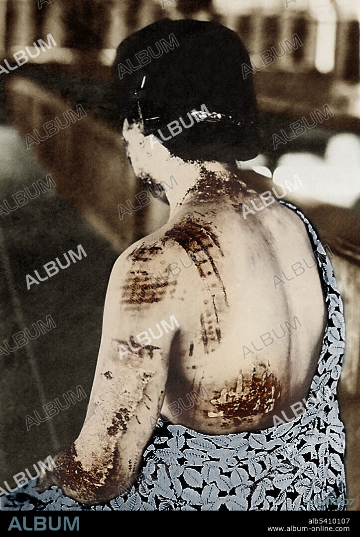 On August 6, 1945, near the end of World War II, the United States dropped an atomic bomb on the Japanese city of Hiroshima, destroying the city and killing over 70,000 people. In this image from a medical report of the bombing, the dark-colored pattern of a woman's clothes is shown to have absorbed thermal energy and burned the skin, particularly around more tight-fitting areas, such as the shoulders.