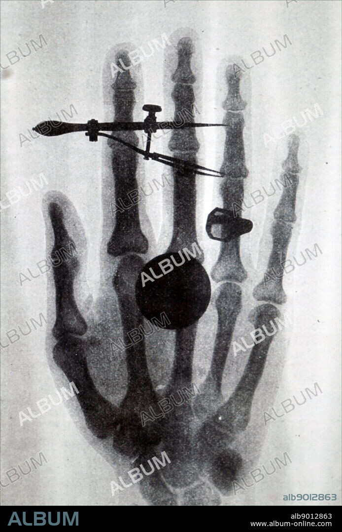 Early Röntgen X-Ray of Wilhelm Röntgen wife's hand. Wilhelm Röntgen (1845-1923) a German mechanical engineer and physicist, who produced and detected electromagnetic radiation in a wavelength range known as X-rays of Röntgen Rays. Dated 19th century.