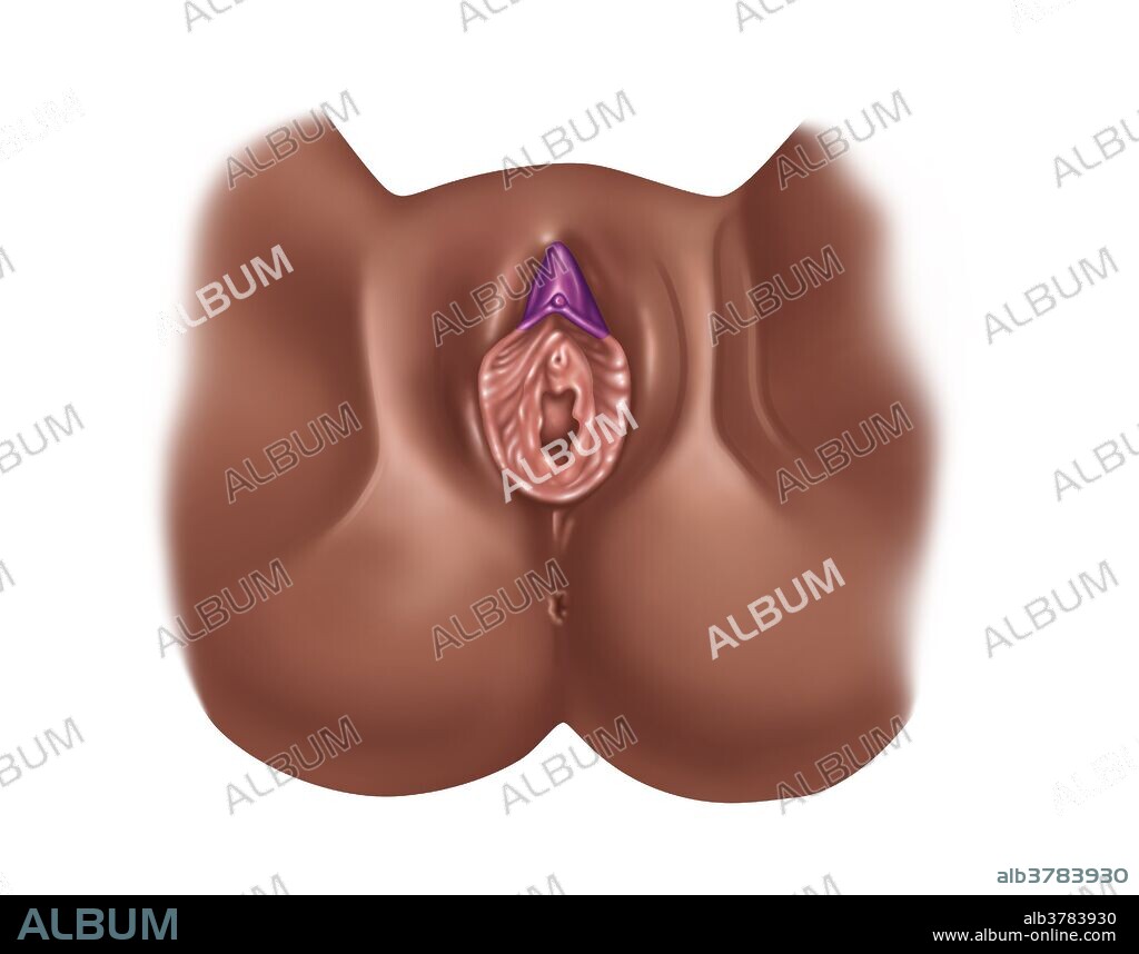 Clitoridectomy, Illustration