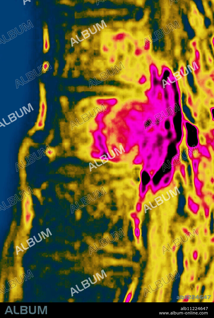 This sagital MRI image of the thoracic spine shows a malignant tumor of a intervertebral disc with medullar compression.