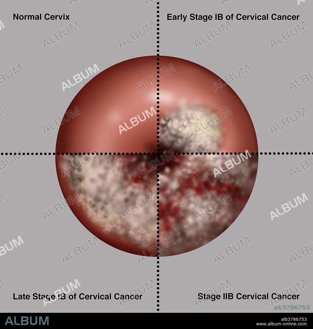 Illustration showing the progression of cervical cancer. Upper left section shows a normal cervix. Upper right section shows the early stage IB of cervical cancer. This stage is defined by clinically visible lesions, less than 4 centimeters across the greatest dimension, limited to the cervix uteri. Lower left shows the late stage IB of cervical cancer, defined by a clinically visible lesion greater than 4 centimeters across its widest dimension. Lower right section shows IIB cervical cancer. This is an advanced stage of the cancer, with extension to the pelvic wall, as seen here. This stage can also result in hydronephrosis (non-functioning kidney). Symptoms of cervical cancer include bleeding between periods, pain after sexual intercourse and heavier periods. Cancer of the cervix is rare and if detected early is almost always cured.