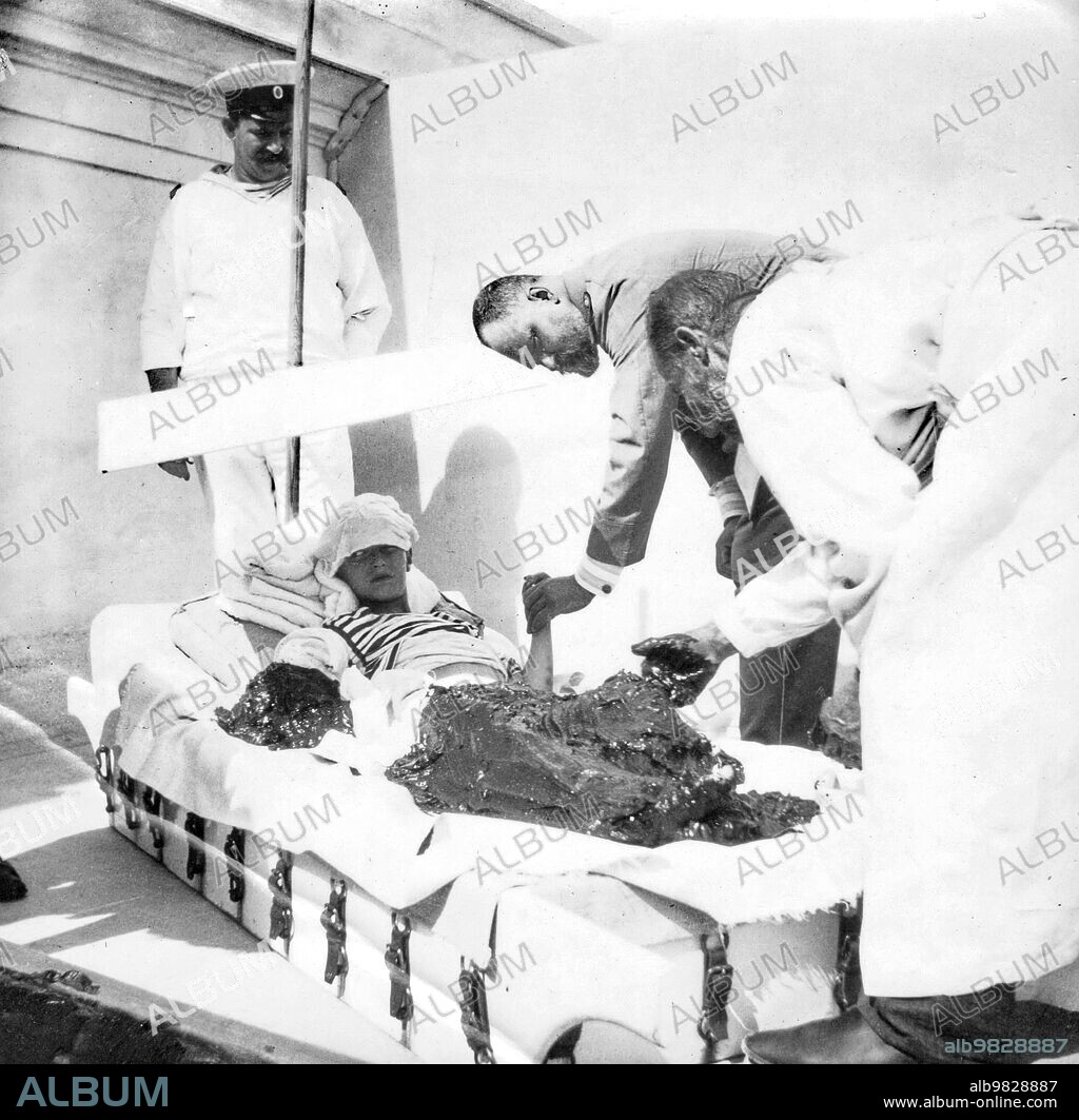 Tsarevich Alexei Nikolaevich of Russia during a mudbath treatment probably to cure his haemophilia at Livadia, Crimea. In the background stands Alexei's sailor nanny Andrei Derevenko, Dr. Botkin holds the left hand of the Tsarevich. ca. early Autumn 1913.