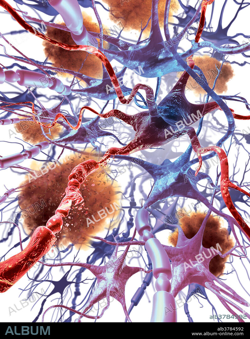 Neuronal Apoptosis In Alzheimer's Disease
