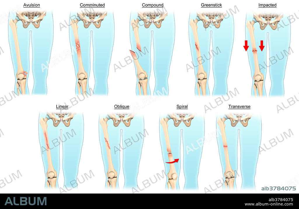 An illustrated diagram depicting various types of fractures. Depicted from top left to right: avulsion, comminuted, compound, greenstick, impacted. From bottom left to right: linear, oblique, spiral, transverse.