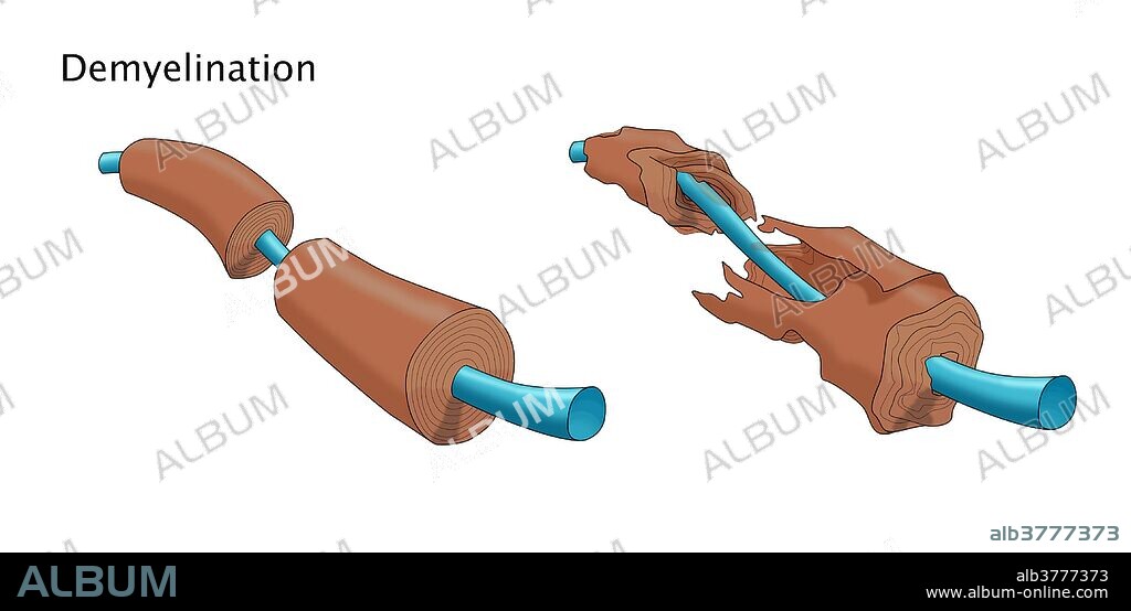 Demyelination. A demyelinating disease is any disease of the nervous system in which the myelin sheath of neurons is damaged.