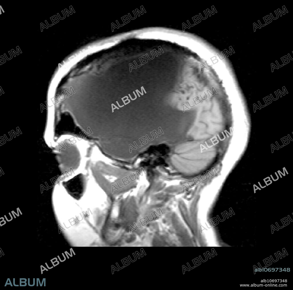This sagital MRI image (T1 sequence) shows near total right hemispherectomy done for intractable seizures. The large gray region is the area previously occupied by the brain. It is now filled with cerebrospinal fluid which takes up the empty space.