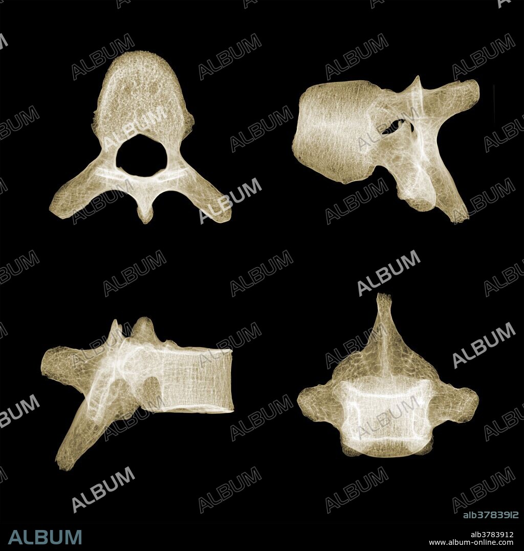 Color-enhanced X-ray showing four different views of human lumbar vertebra T5.
