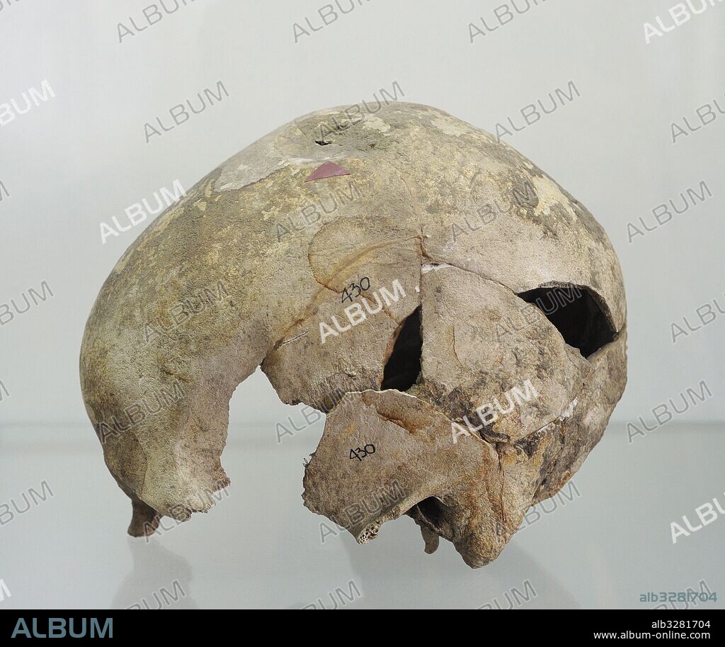 Poland. Prehistory. Human skull with marked trace of the blow with a blunt instrument. It is presented in a permanent exhibition "Disease prehistoric population on Polish soil". Archaeological Museum. Gdansk. Poland.
