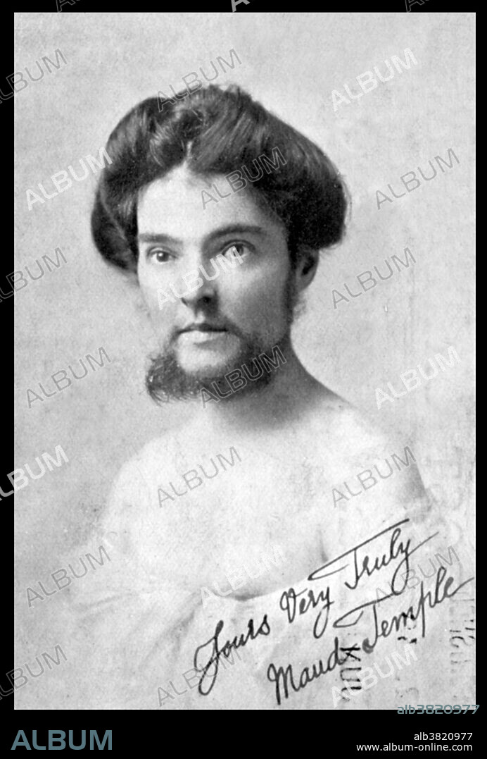 Maud Temple, a bearded lady at Pickard's Waxwork exhibition, Glasgow, 1910. She was a popular 'bearded lady' who made appearances in England and Australia. A relatively small number of women are able to grow enough facial hair to have a distinct beard. In some cases, female beard growth is the result of a hormonal imbalance (usually androgen excess), or a rare genetic disorder known as hypertrichosis. Sometimes it is caused by use of anabolic steroids. Cultural pressure leads most to remove it, as it may be viewed as a social stigma. Bearded ladies were, and still are, a staple of a carnival sideshow.