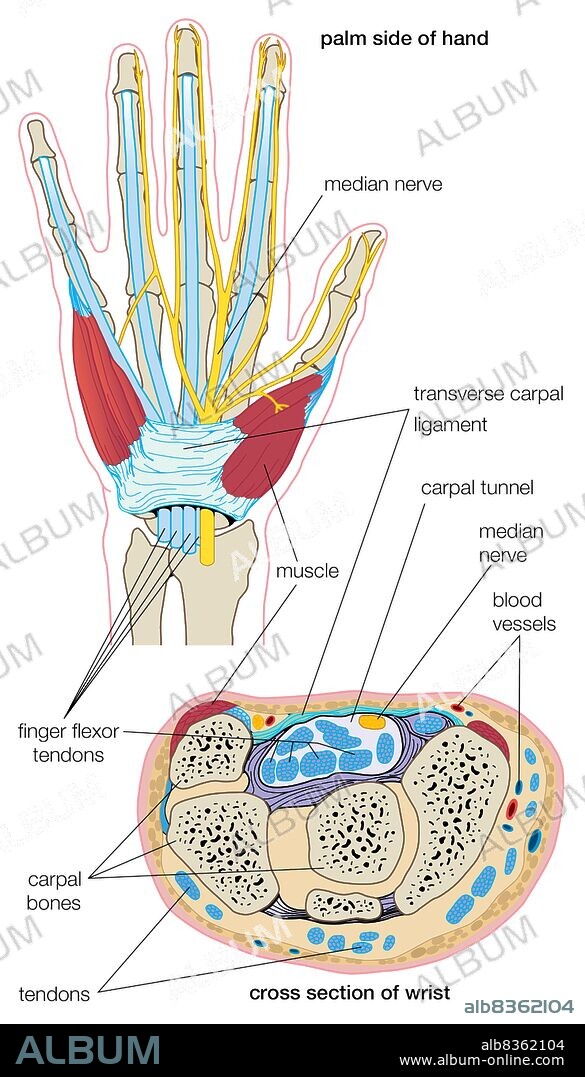 Carpal tunnel syndrome.