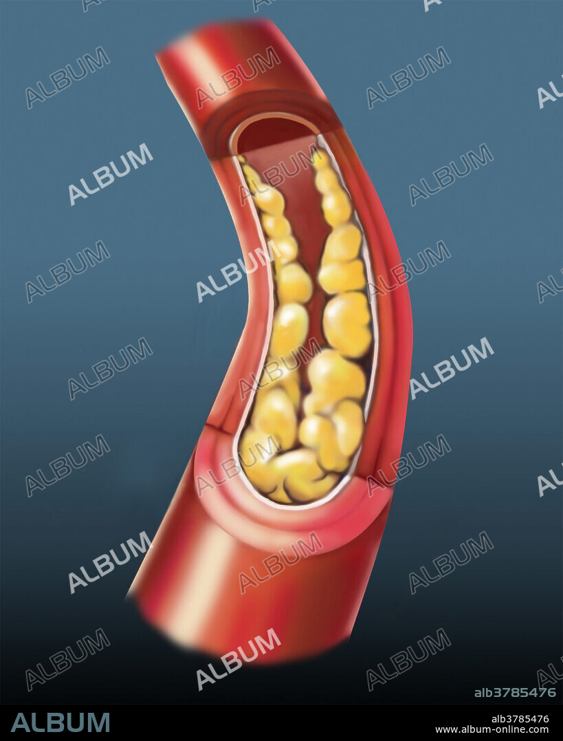 Medical illustration of a cross-sectional blood vessel showing atherosclerotic changes. Plaque buildup lines the inside of the vessel.