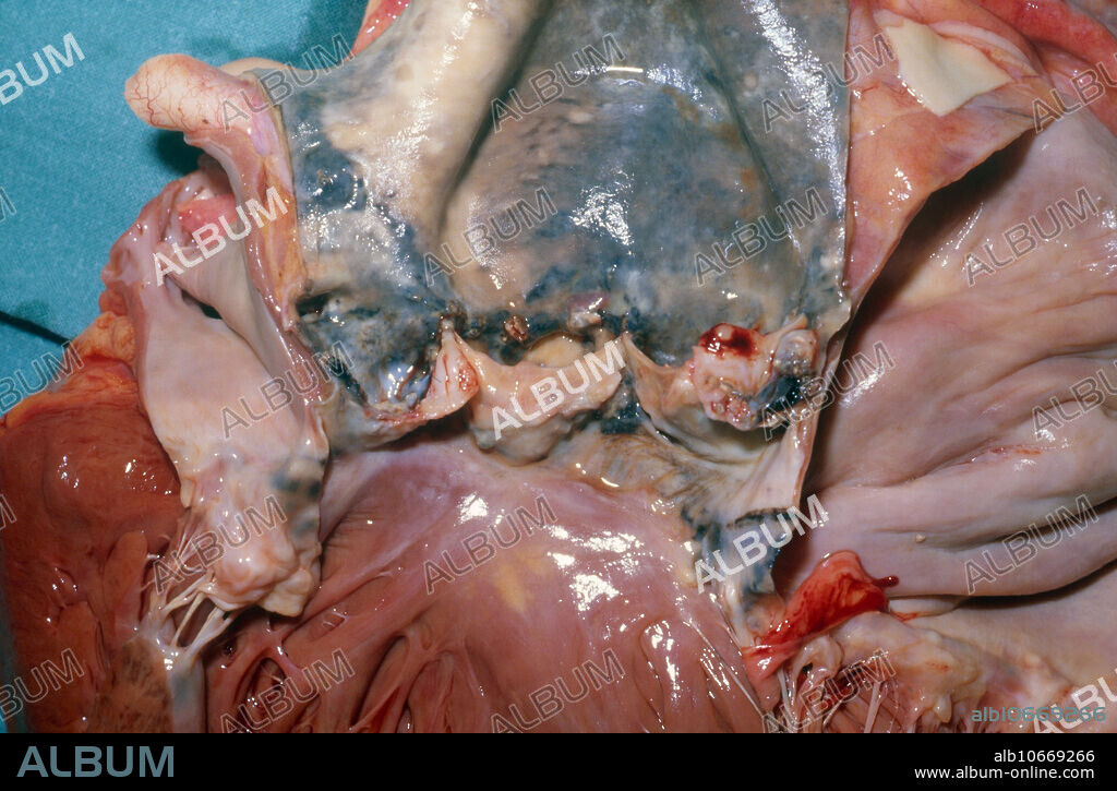 Close-up of aortic valve affected by ochronosis, a rare condition in which body tissues become stained by black pigment; may be congenital or due to carbolic poisoning. Stenosis can results from the increased rigidity of the connective tissue as well as chronic inflammation.