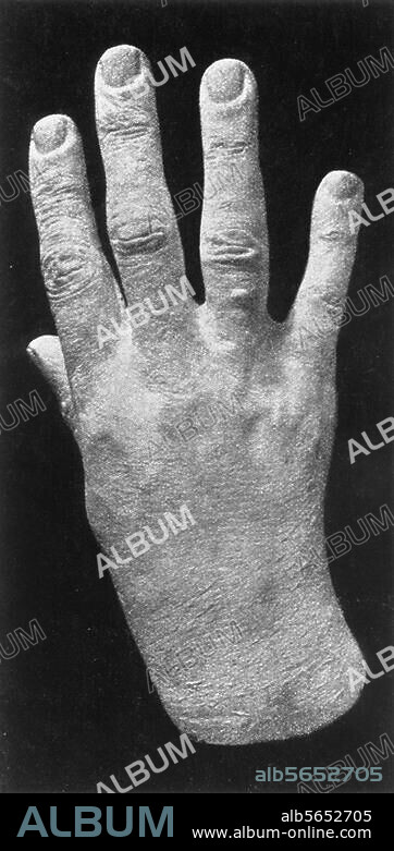 Liszt, Franz Pianist and composer. Raiding 22.10.1811 - Bayreuth 31.7.1886. Liszt's rigth hand in his later years. Plaster cast.