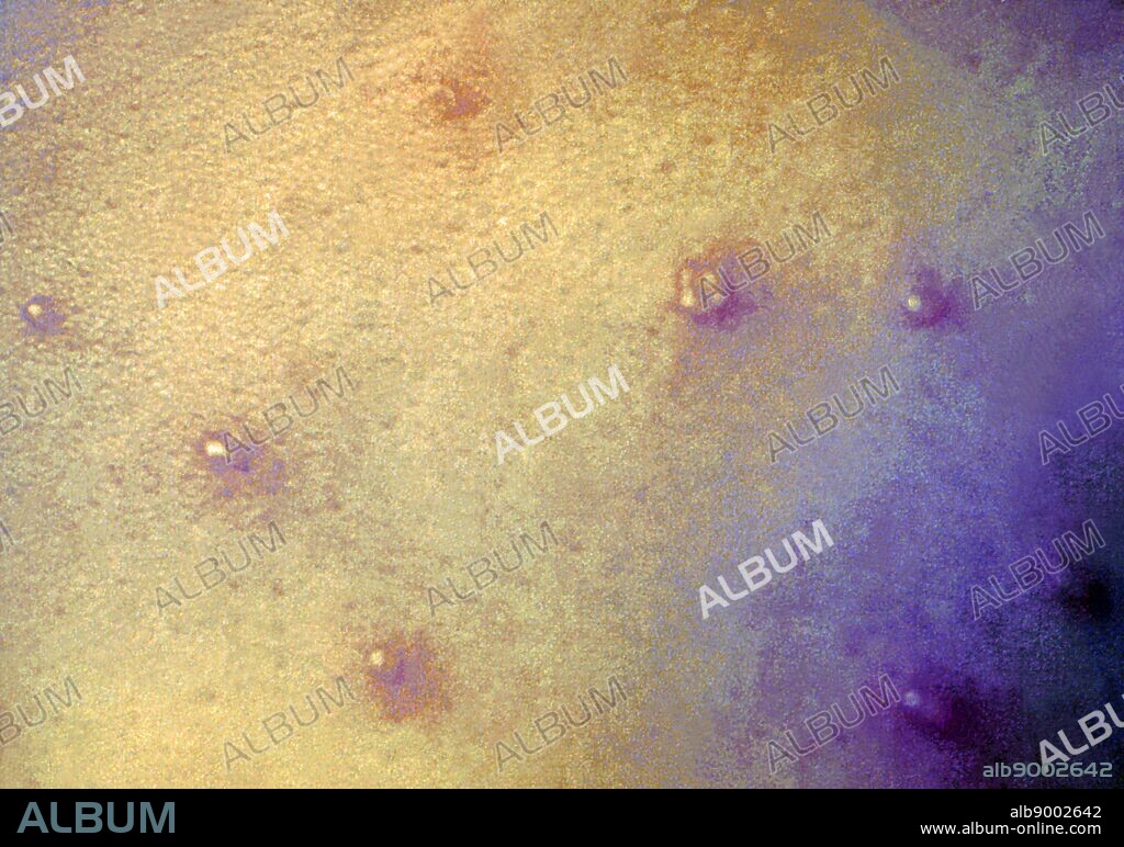A close-up of a maculopapular rash, diagnosed as chickenpox lesions. Anyone who hasn't had chickenpox or received the chickenpox vaccine can get the disease. The classic symptom of chickenpox is a rash that turns into itchy, fluid-filled blisters that eventually turn into scabs.