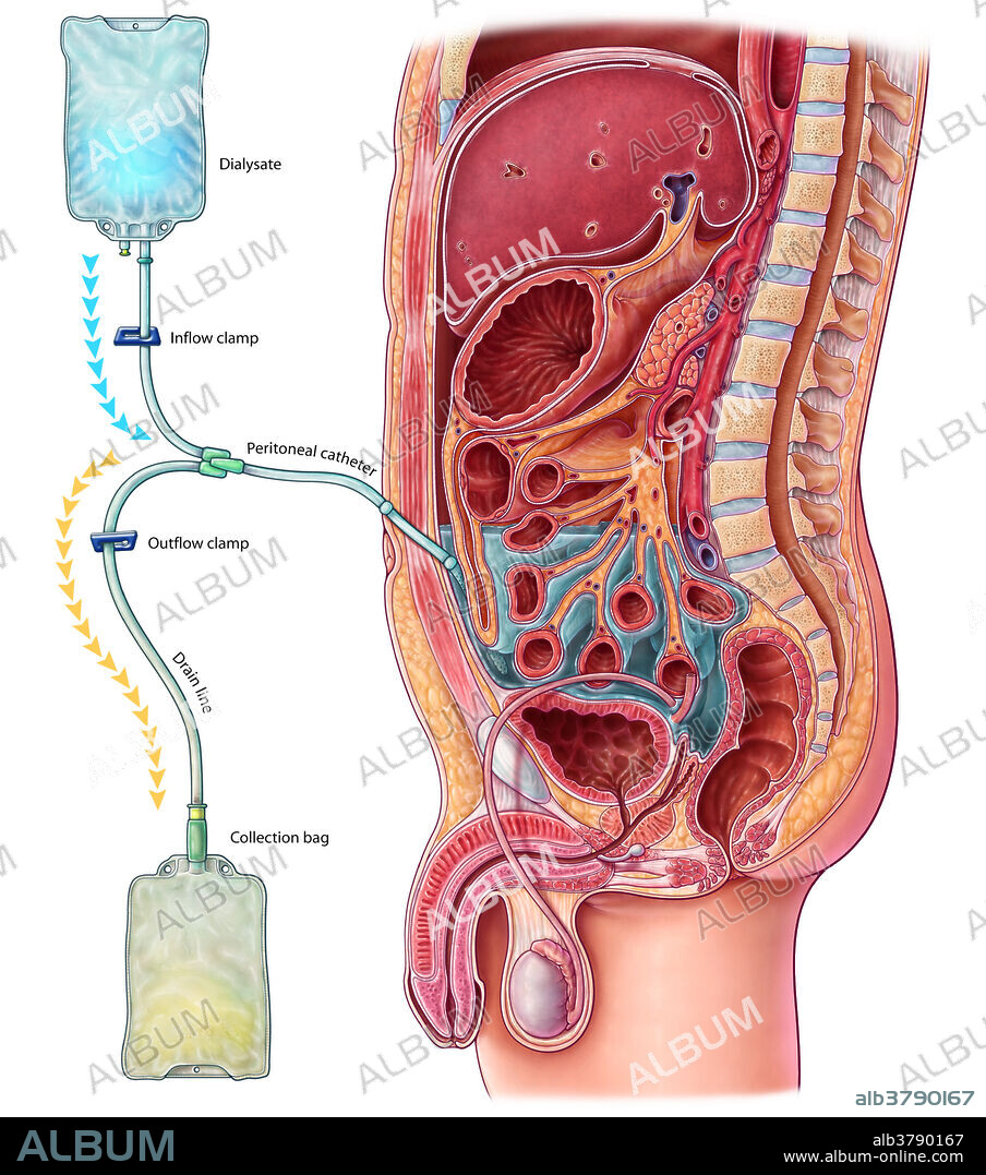 An illustration of peritoneal dialysis, a method used to remove waste from the blood when the kidneys cannot properly function. A catheter is placed into the abdomen and connected to a bag of dialysis solution, known as dialysate. As the solution fills the inside of the abdomen, waste products in the blood diffuse through the peritoneum over the course of four to six hours. The waste fluid is then drained into a separate collection bag and replaced with fresh dialysate. The process is repeated around four to six times a day, keeping two litres of fluid in the abdomen at all times. Peritoneal dialysis is a less common method of filtering blood than haemodialysis, but it allows patients to treat themselves at home or work, and may result in longer lasting residual kidney function and a more stable blood chemistry and hydration level.