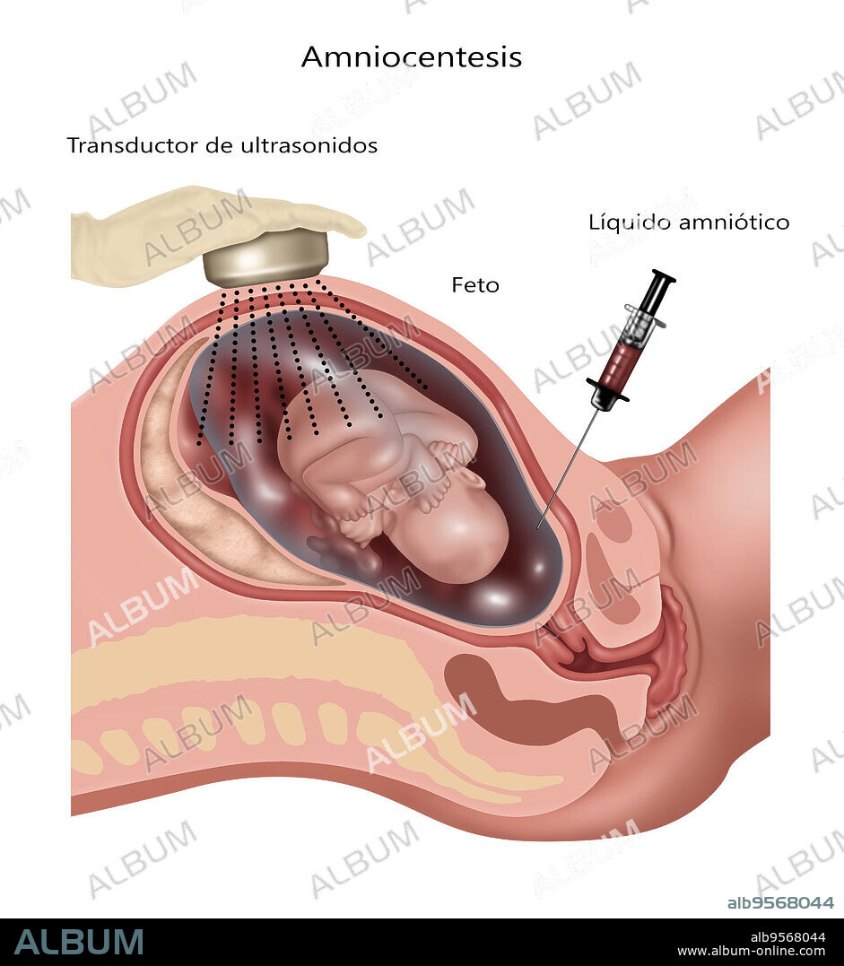 Illustration of amniocentesis.