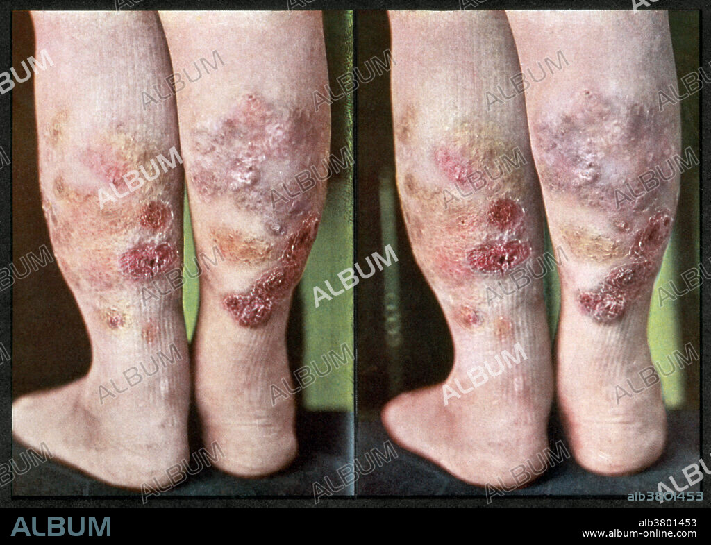 Vintage stereoscopic print from 1910, used to aid in the diagnosis and treatment of dermatological ailments. Here, a patient with Erythema induratum, or Bazin disease, a panniculitis on the back of the calves.