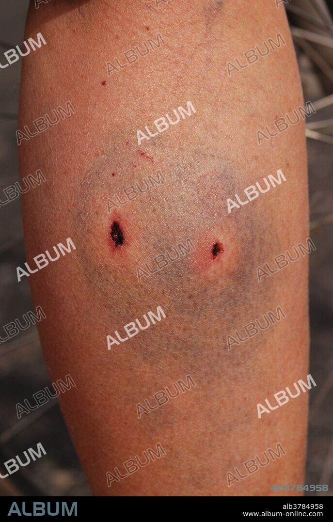 Close up of a puncture wound on a man's calf.