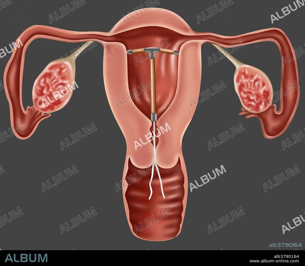 Illustration of an IUD contraceptive device inserted through the cervix and into the uterus.