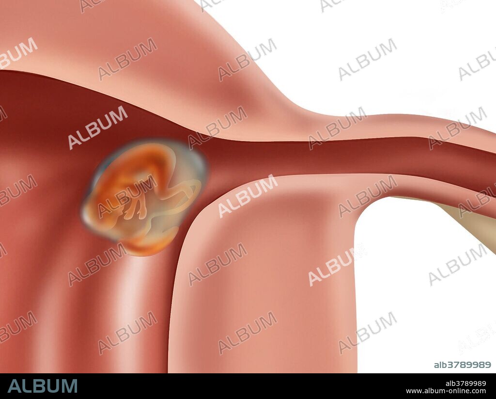 Illustration of a cornual/interstitial ectopic pregnancy. In an interstitial ectopic pregnancy the fetus grows outside of the uterine cavity. If the pregnancy goes undetected the fallopian tube will eventually burst, causing hemorrhaging into the mother's abdomen, which may be fatal. Surgery is performed to remove the fetus and repair or remove the Fallopian tube. In the image shown, at left is the entire uterus with a box around the area where the fetus is growing. At right is a close up of the fetus in the passageway to the fallopian tube.