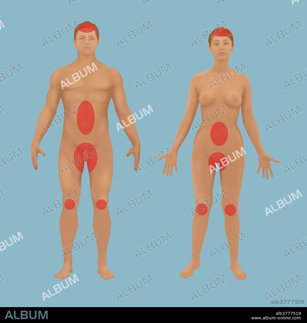 Illustration of common areas affected by psoriasis.