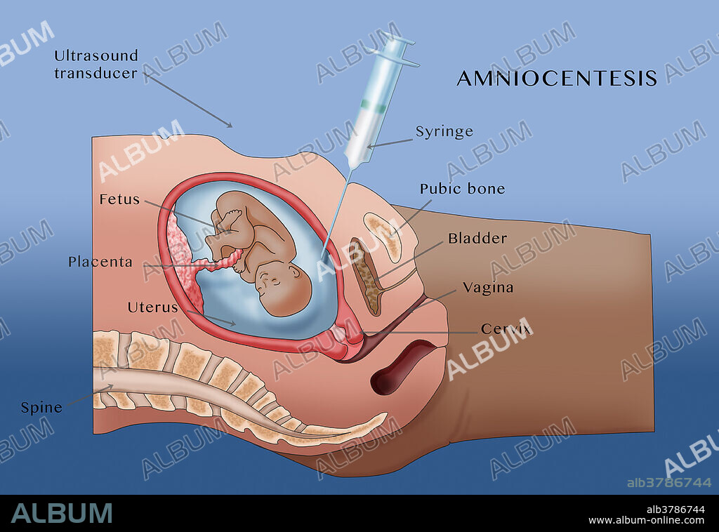 Illustration of amniocentesis (amniotic fluid test or AFT), a medical procedure in which a small amount of amniotic fluid, containing foetal tissues, is sampled and tested for chromosomal abnormalities and foetal infections.