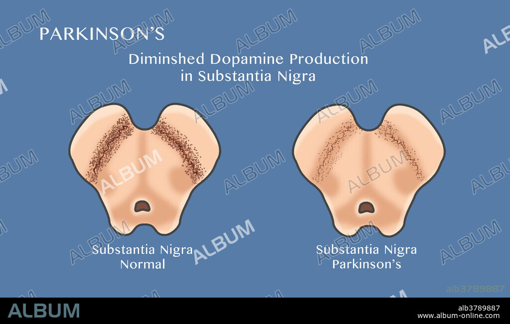 Illustration showing degeneration of dopaminergic neurons in the substantia nigra of the midbrain. At left is a normal substantia nigra at right is a diminished substantia nigra. Degeneration of this structure is characteristic of Parkinson's disease.