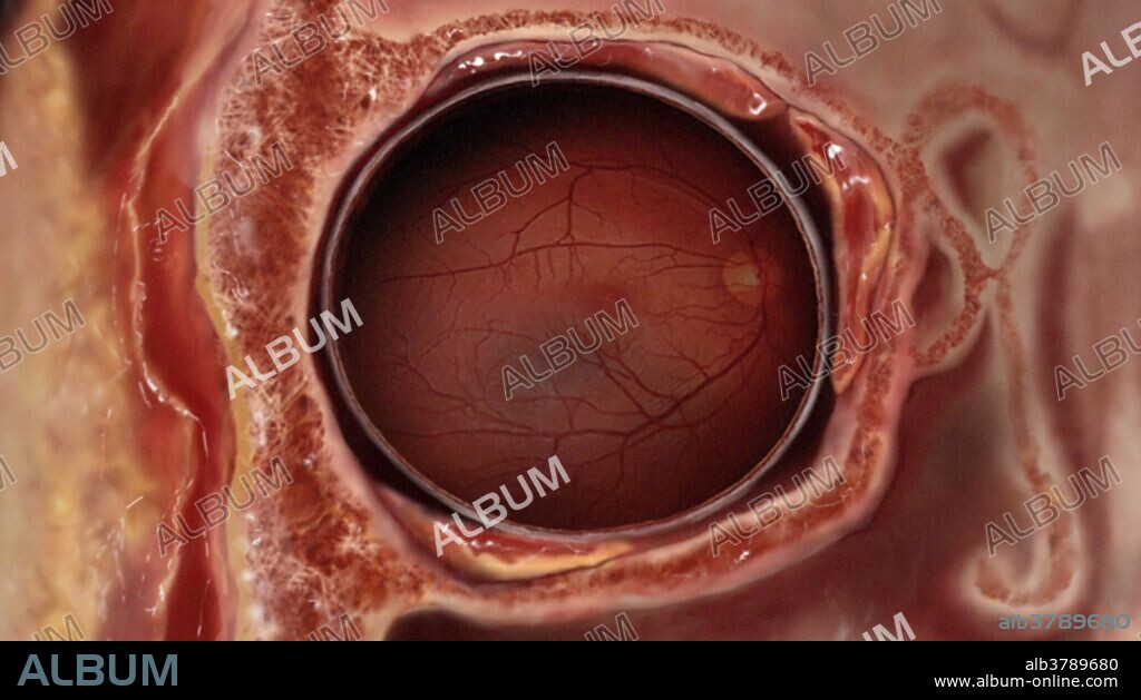 Coronal section of the eye. The vitreous chamber is shown, along with the optic nerve (orange spot within the vitreous chamber) and retinal blood vessels.