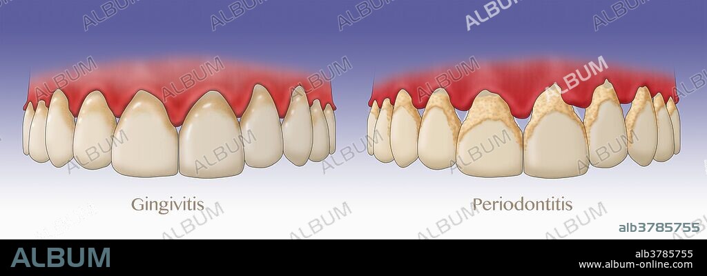Comparison of gingivitis & periodontitis. Illustration.