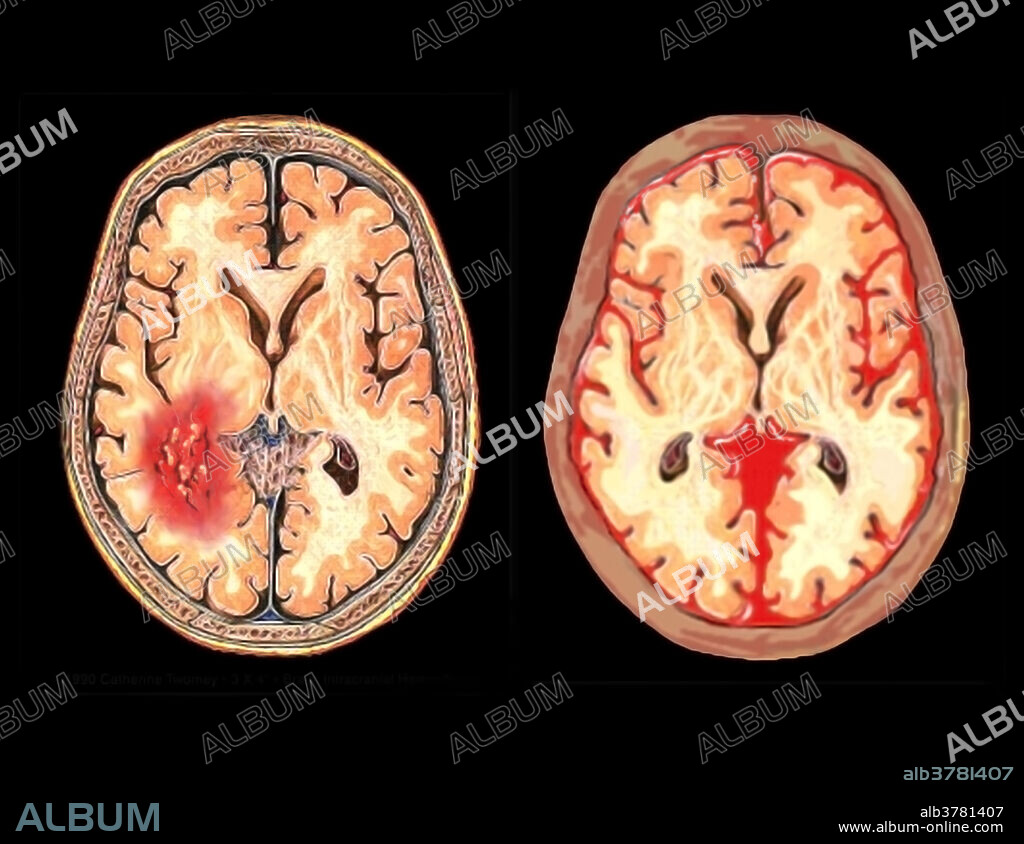 Medical illustration of two types of brain injuries, a subarachnoid haemorrhage (left) and a subdural hematoma (right). Subarachnoid haemorrhage (SAH) is bleeding into the subarachnoid space, the area between the arachnoid membrane and the pia mater surrounding the brain. A subdural hematoma, also known as a subdural haemorrhage (SDH), is a type of hematoma, usually associated with traumatic brain injury. Blood gathers between the inner layer of the dura mater and the arachnoid mater.