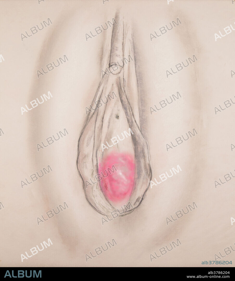 The imperforate hymen completely covers the vagina. Minor surgery is often required to allow menstrual flow to escape, for the insertion of tampons, or for sexual intercourse.
