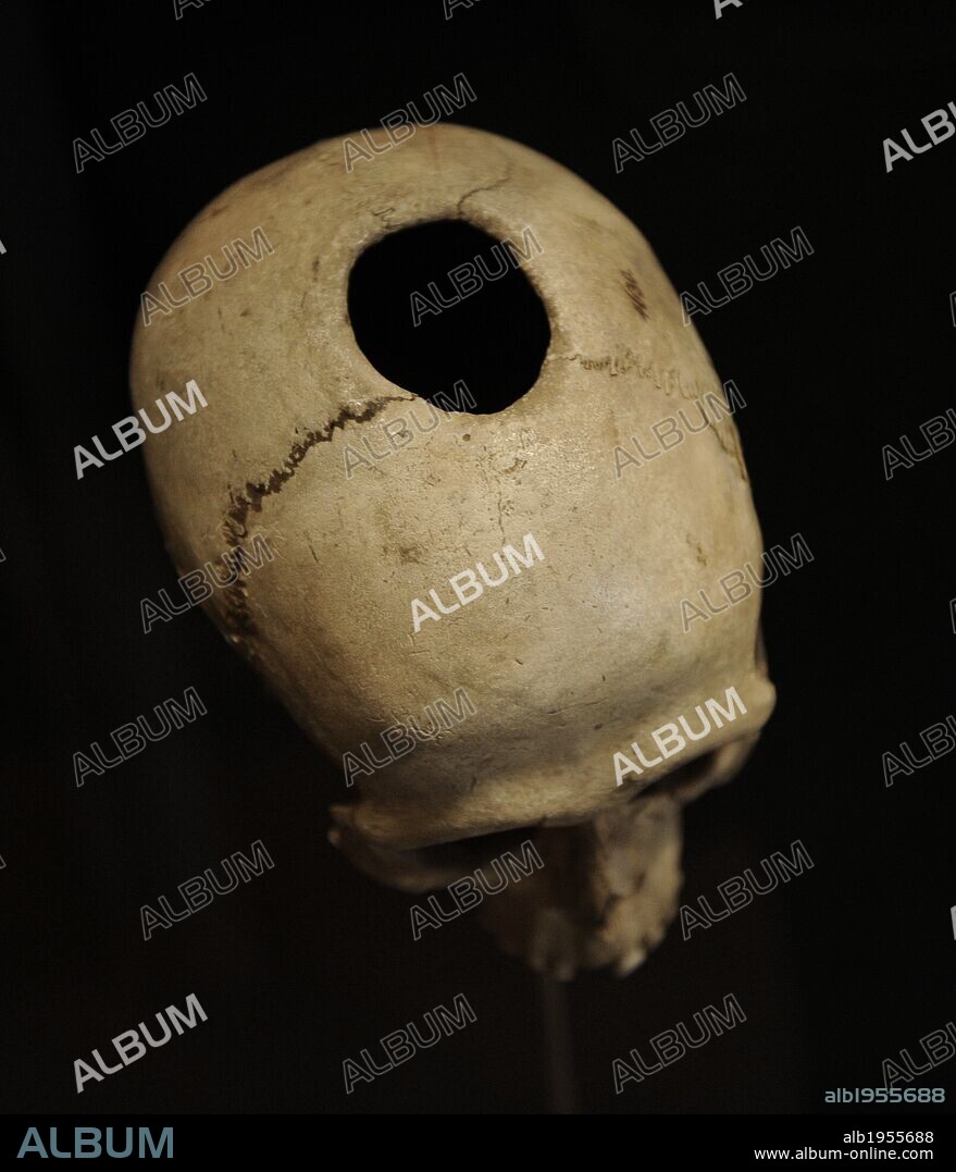 ARTE. PREHISTORIA. EUROPA. NEOLITICO. Trepanación de un cráneo procedente de una tumba, cerca de Næs en Falster. Las lesiones en la cabeza fueron tratados con trepanación. Museo Nacional. Copenhague. Dinamarca. Europa.