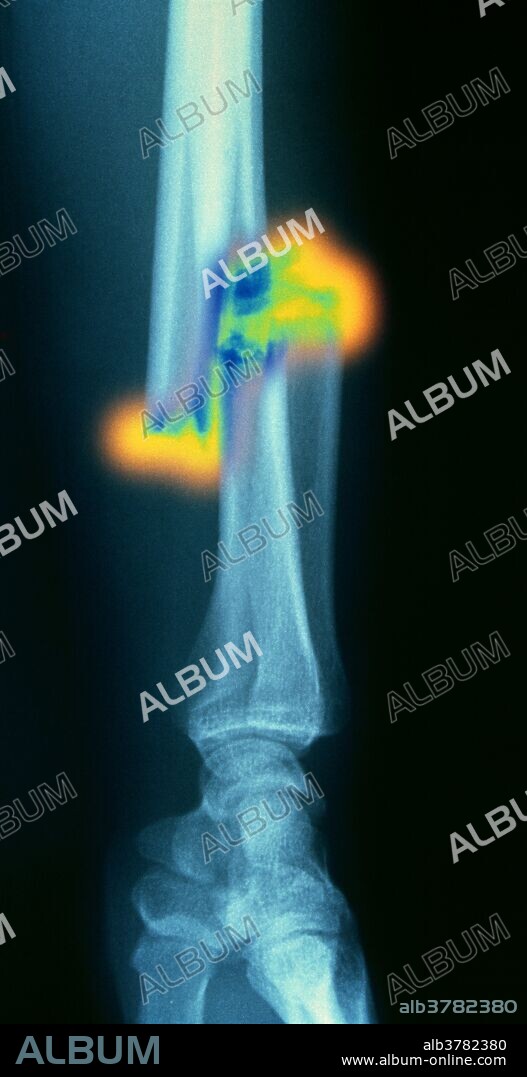 Broken arm. Colored X-ray of displaced fractures of the radius and ulna (lower arm bones) in a 21 year old man. The radius is in the foreground and the smaller ulna is visible behind the radius. The bones of the hand are at lower center. The bone alignment is no longer true & the fractured ends have separated. Most fractures are caused by a sudden injury that exerts more force on the bone than it can withstand. X-rays are used to confirm the diagnosis and to provide an accurate picture of the type of fracture. Bone begins to heal immediately, so it is important that the broken ends are correctly aligned. The bone is then immobilized to allow the broken pieces to unite firmly.
