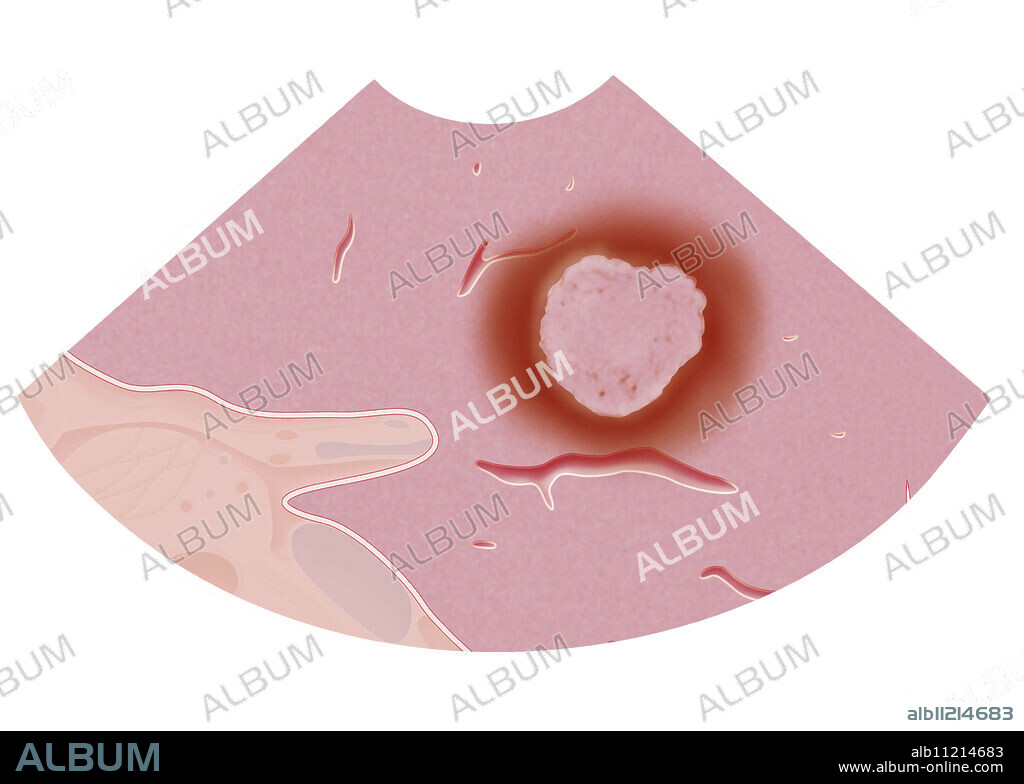 Illustration of the ablation of a tumor in the liver by radiofrequency ablation. Within a few minutes the tumor has been destroyed and the electrode can be removed. The doctor checks that the tumor has been destroyed using medical imaging.