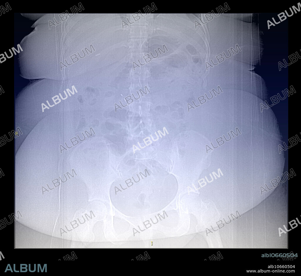 This colour-enhanced frontal X-ray of a person with morbid obesity shows the extensive redundancy of skin folds and fat deposition. The difficulty in seeing the underlying bones is related to the attenuation of the X-ray beam from the excess soft tissue.