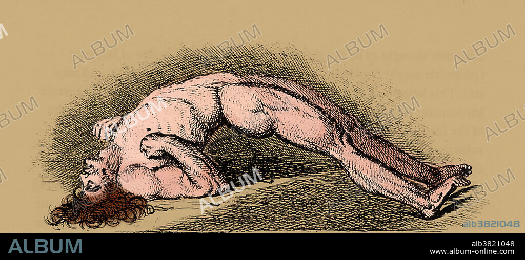 Greek illustration of a man suffering Opisthotonus ( the backward spasm ) and lockjaw, the terrifying symptoms of tetanus. For Greeks, spasms in general were diseases, not symptoms; the simplest was shivering.