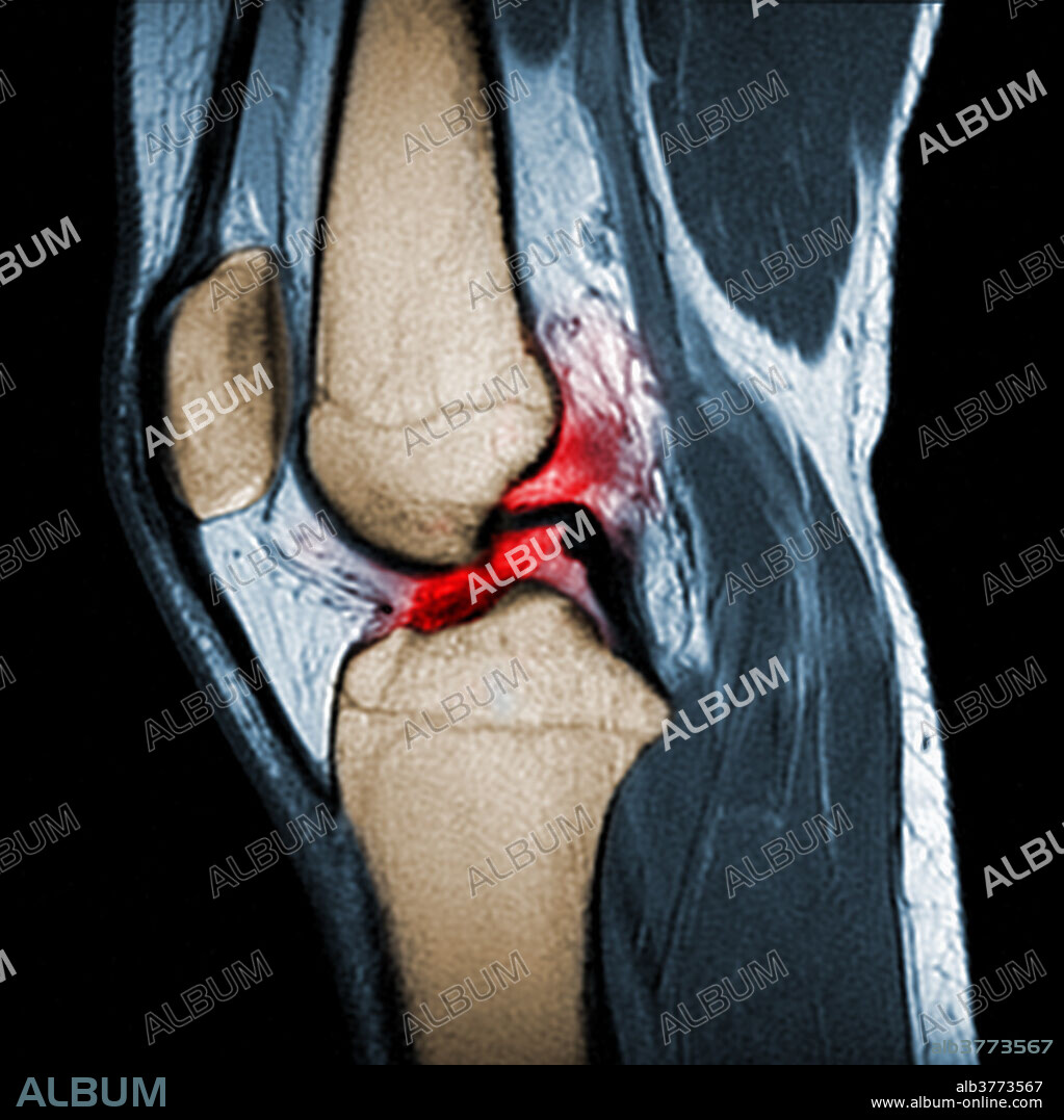 Magnetic Resonance Imaging (MRI) of a knee with a fully torn anterior cruciate ligament (ACL) (area in red). The ACL is a ligament which joins the femur and tibia, and is a commonly injured in sports such as soccer, basketball, tennis, skiing and football. A torn ACL can cause swelling, instability and pain in the knee joint, and may require surgery and physical therapy.