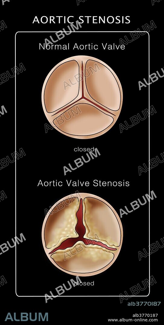 Illustration of a closed normal aortic valve (above) compared to a closed aortic valve stenosis (below).