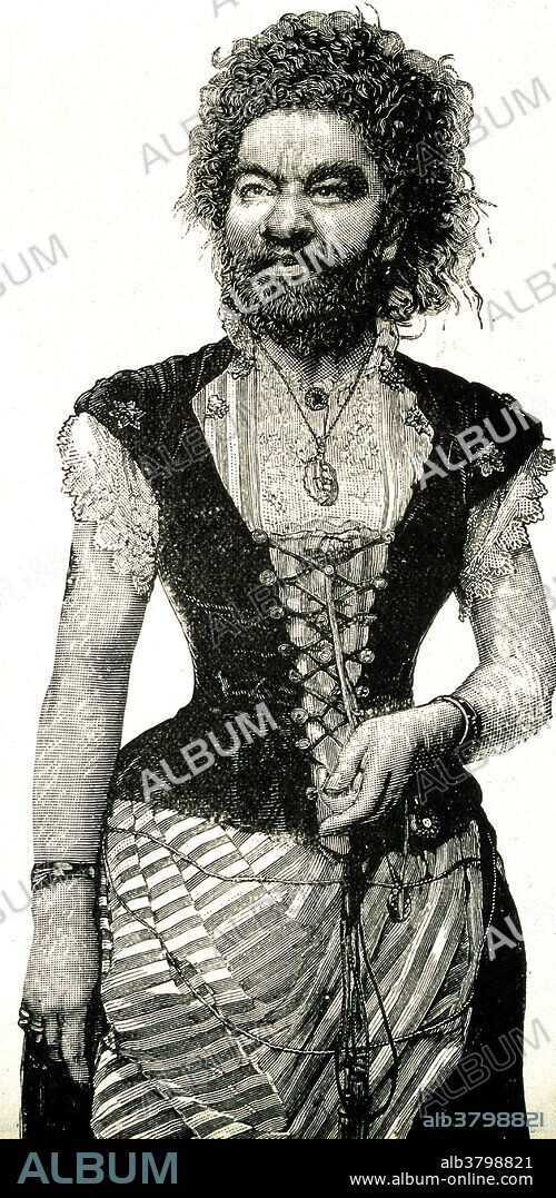 Julia Pastrana (1834 - March 25, 1860) was a woman born with hypertrichosis, who took part in 19th century exhibition tours in North America and Europe. She was born with a genetic condition, hypertrichosis terminalis, her face and body were covered with straight black hair. Her ears and nose were unusually large, and her teeth were irregular. The latter condition was caused by a rare disease, undiagnosed in her lifetime, Gingival hyperplasia, which thickened her lips and gums. She was advertised as a hybrid between an ape and a human, and as a "Bear Woman". During a tour in Moscow, Pastrana gave birth to a baby with features similar to her own. The child survived only three days, and Pastrana died of postpartum complications five days later. Hypertrichosis (also called Ambras syndrome) is an abnormal amount of hair growth over the body. Extensive cases of hypertrichosis have informally been called werewolf syndrome, because the appearance is similar to the werewolf.
