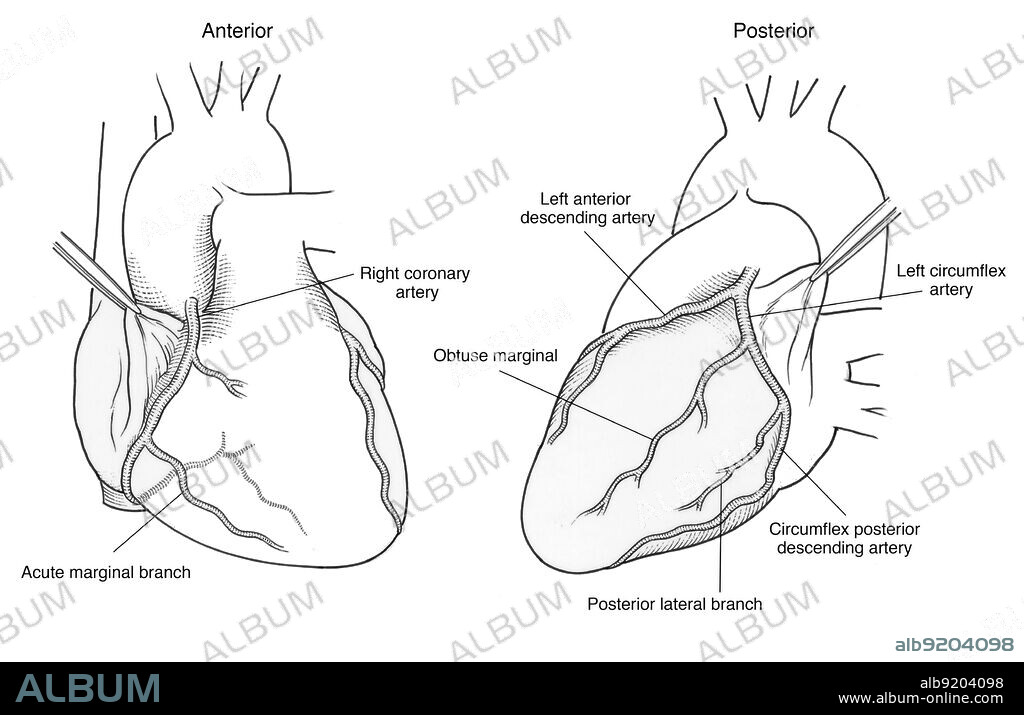 Anatomical illustration of the arteries of the heart, showing (on anterior) right coronary artery, acute marginal branch, and (on posterior) left anterior descending artery, obtuse marginal, left circumflex artery, circumflex posterior descending artery, and posterior lateral branch.
