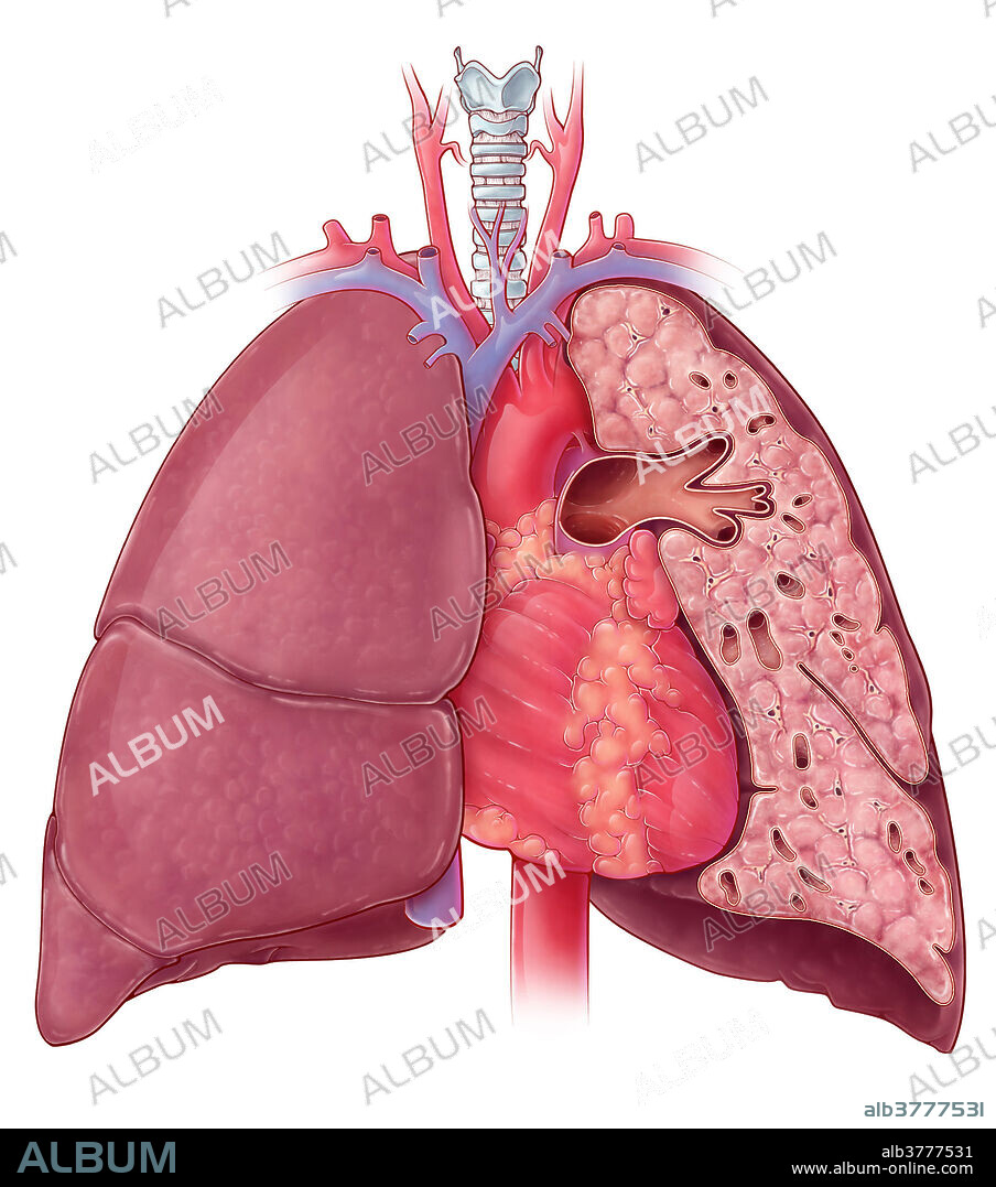 An illustration of the heart and lungs, with a cross-sectional view of the left lung showcasing branches of the left pulmonary arteries.