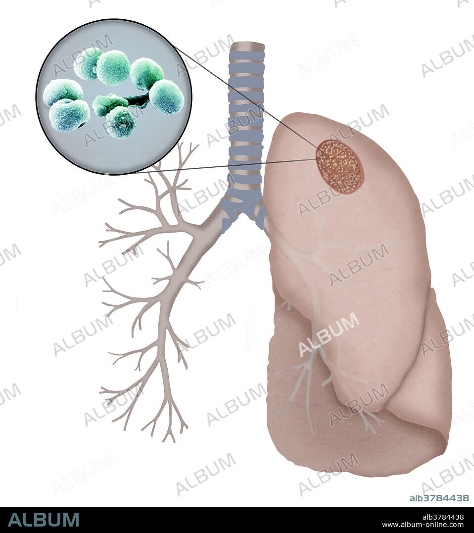 Streptococcus pneumoniae is a gram-positive bacteria often found in chains or pairs. Streptococcus is part of the normal human bacterial flora, and as such, is carried by many without causing infection. However, in immune compromised individuals it can infect the upper respiratory tract, causing pneumonia. It may also infect other parts of the body, causing bacterial blood poisoning (bacteraemia) and meningitis.